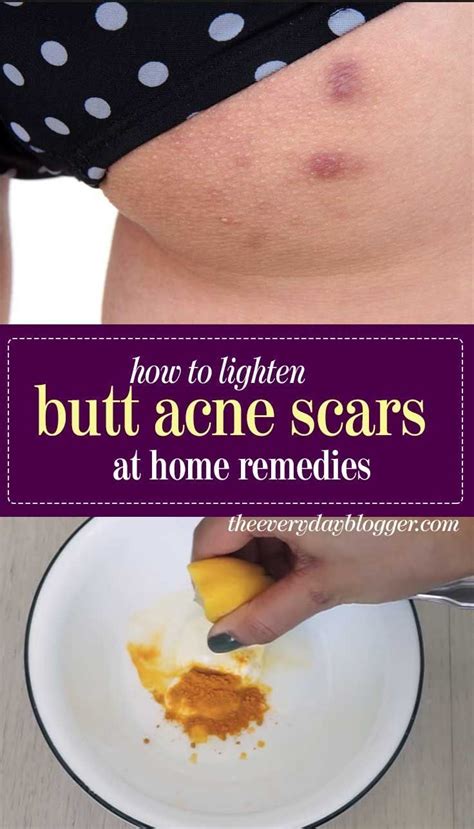What Cause Acne On Your Buttocks